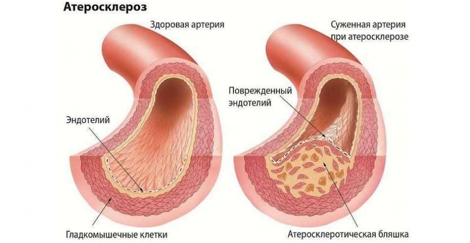 Атеросклероз нижних конечностей
